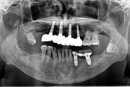 インプラントブリッジ症例のAFTER画像